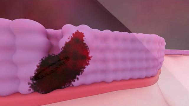 Papilloma virus, open day per la vaccinazione in Toscana - Jdo_iObdsf0